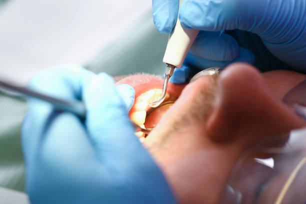 Best Knocked-Out Tooth (Avulsed Tooth) Treatment in West Milwaukee, WI